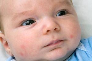 Baby & toddler rashes