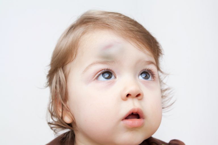 Did Your Toddler Hit Their Head? BabySparks