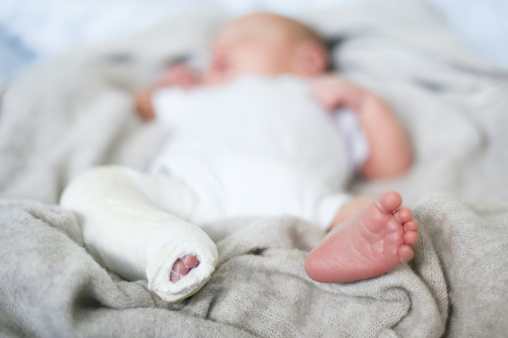 what-is-clubfoot-babysparks